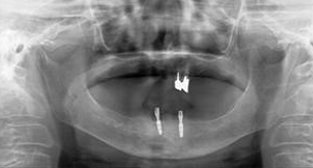 ⑦インプラント・デンチャー