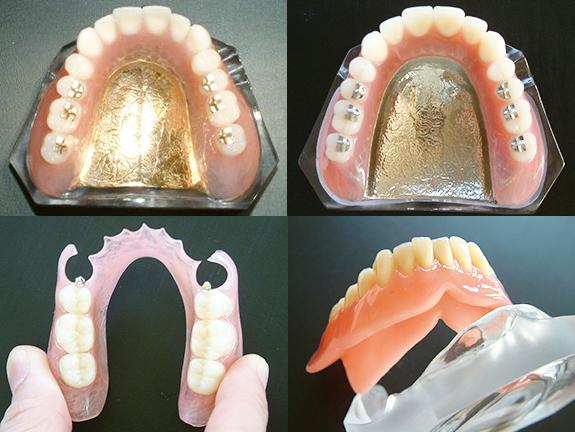 入れ歯の種類
